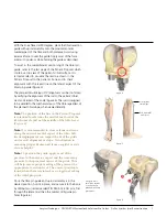 Preview for 5 page of Johnson & Johnson Depuy Synthes Trumatch Surgical Technique