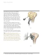 Preview for 6 page of Johnson & Johnson Depuy Synthes Trumatch Surgical Technique