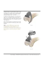 Preview for 9 page of Johnson & Johnson Depuy Synthes Trumatch Surgical Technique