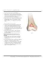 Preview for 13 page of Johnson & Johnson Depuy Synthes Trumatch Surgical Technique