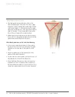 Preview for 14 page of Johnson & Johnson Depuy Synthes Trumatch Surgical Technique