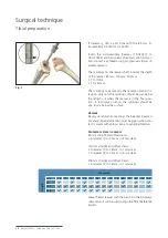 Preview for 10 page of Mathys balanSys REV Surgical Techniques