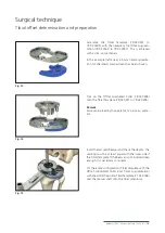 Preview for 15 page of Mathys balanSys REV Surgical Techniques