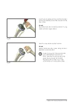 Preview for 23 page of Mathys balanSys REV Surgical Techniques