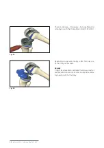 Preview for 44 page of Mathys balanSys REV Surgical Techniques