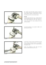 Preview for 56 page of Mathys balanSys REV Surgical Techniques