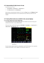 Preview for 52 page of Mindray BeneView T1 Operator'S Manual