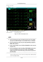 Preview for 172 page of Mindray PM-9000 Operation Manual