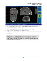 Предварительный просмотр 64 страницы Monteris Medical Neuroblate Instructions For Use Manual