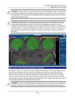 Предварительный просмотр 143 страницы Monteris Medical Neuroblate Instructions For Use Manual