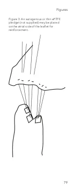 Предварительный просмотр 79 страницы On-X CHORD-X ePTFE SUTURE Instructions For Use Manual