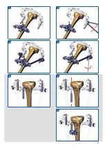 Предварительный просмотр 57 страницы Orthofix Galaxy-TL-HEX Manual