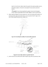 Предварительный просмотр 13 страницы SALUDA MEDICAL Evoke 12C Surgical Manual