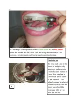 Preview for 10 page of SleepMD Anti-Snore Mouthpiece Instructions Manual