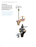 Preview for 18 page of smith&nephew LEGION Cones Surgical Technique