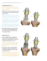 Preview for 20 page of smith&nephew LEGION Cones Surgical Technique