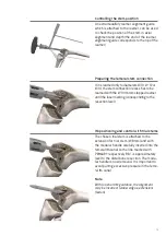 Preview for 21 page of smith&nephew RT-PLUS Surgical Technique