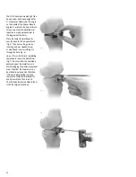 Preview for 24 page of smith&nephew ZUK Surgical Techniques