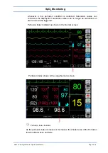 Preview for 122 page of Spacelabs Healthcare 93300 Operation Manual