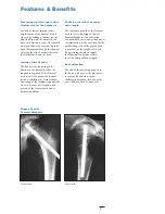 Preview for 5 page of Stryker Hansson Pin System Manual