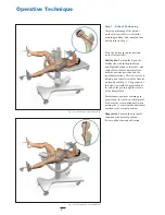 Preview for 6 page of Stryker Hansson Pin System Manual