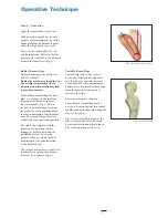 Preview for 7 page of Stryker Hansson Pin System Manual