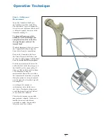 Preview for 11 page of Stryker Hansson Pin System Manual