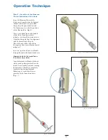 Preview for 13 page of Stryker Hansson Pin System Manual