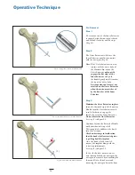 Preview for 16 page of Stryker Hansson Pin System Manual