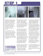 Preview for 4 page of Stryker SECUR-FIT ADVANCED Surgical Technique