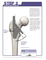 Preview for 5 page of Stryker SECUR-FIT ADVANCED Surgical Technique