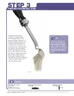 Preview for 6 page of Stryker SECUR-FIT ADVANCED Surgical Technique