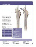 Preview for 9 page of Stryker SECUR-FIT ADVANCED Surgical Technique