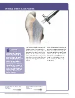 Preview for 11 page of Stryker SECUR-FIT ADVANCED Surgical Technique