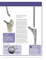 Preview for 15 page of Stryker SECUR-FIT ADVANCED Surgical Technique