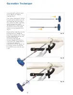 Preview for 20 page of Stryker T2 Operative Technique