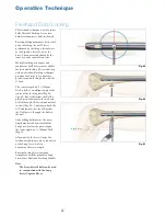 Preview for 32 page of Stryker T2 Operative Technique