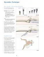 Preview for 34 page of Stryker T2 Operative Technique