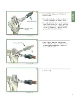 Preview for 17 page of Stryker Triathlon Knee System Surgical Protocol