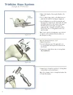 Preview for 28 page of Stryker Triathlon Knee System Surgical Protocol