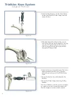 Preview for 34 page of Stryker Triathlon Knee System Surgical Protocol