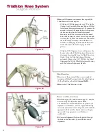 Preview for 42 page of Stryker Triathlon Knee System Surgical Protocol