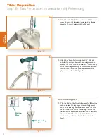 Preview for 26 page of Stryker Triathlon Tritanium Surgical Manualline