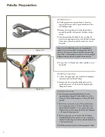 Preview for 34 page of Stryker Triathlon Tritanium Surgical Manualline