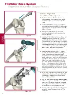 Preview for 12 page of Stryker Triathlon Surgical Manualline