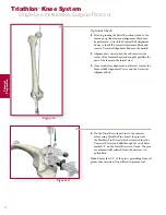 Preview for 14 page of Stryker Triathlon Surgical Manualline