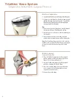 Preview for 32 page of Stryker Triathlon Surgical Manualline