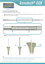 Preview for 5 page of Surgival Genutech CCK Surgical Technique