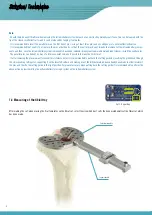 Preview for 10 page of Surgival Genutech CCK Surgical Technique