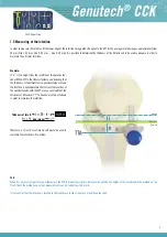 Preview for 11 page of Surgival Genutech CCK Surgical Technique